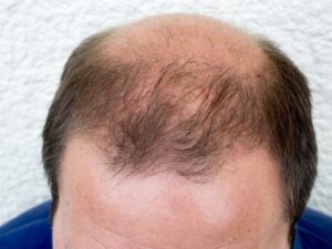 Baldness Cure