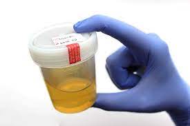 Urine Abnormal Color: Urine Color Indication Of Health Problems