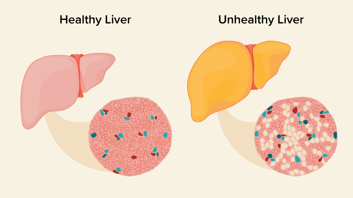 Liver Health