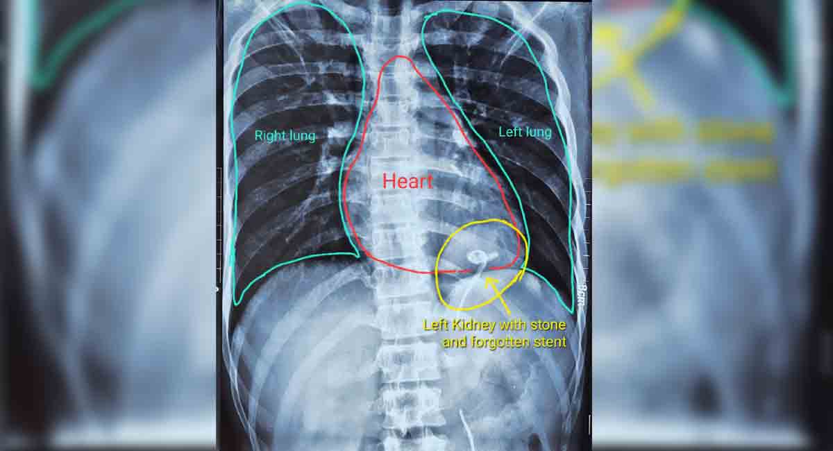 NIMS Hospital Thoracic kidney