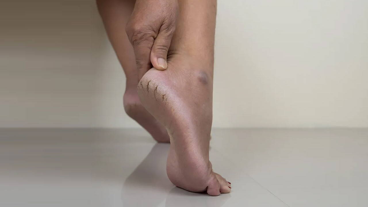 Natural remedies for cracked heels
